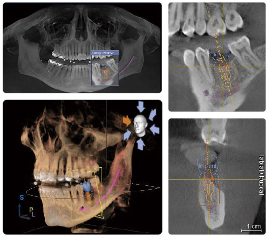 悅庭獨創《All RIGHT溫柔植牙技術》Intelligence 智慧：3D全口斷層掃瞄取得齒槽骨、神經、鼻竇位置等完整資訊，提升植牙安全性