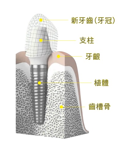 植牙結構示意圖：將植體植入齒槽骨中，搭配支柱、牙冠重建牙齒，咬合穩定更耐用
