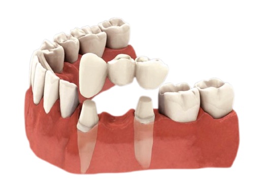 傳統牙橋使用相鄰的牙齒作為固定基台，須磨小兩側健康的牙齒。植牙有完整保留健康真牙的優點