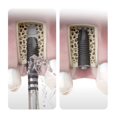 植牙過程階段一：植入人工牙根（植體）