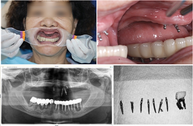 植牙失敗重建案例，患者口內的臨時性細小植體出現多顆植體斷裂問題