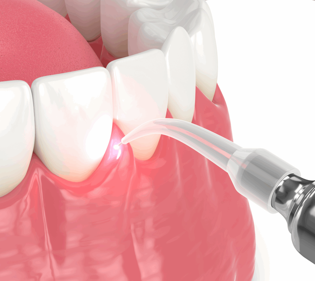 水雷射牙周病治療