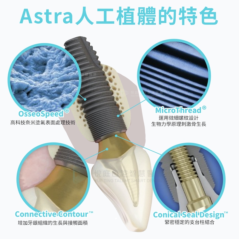 Astra植體的特色在於使用的四種表面處理技術，包含：高科技奈米塗氟表面處理技術、運用微細螺紋設計以生物力學原理刺激骨生長、增加牙齦組織的生長與接觸面積、緊密穩定的支台柱結合
