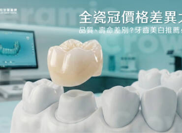 全瓷冠價格差異大？品質、壽命差別？牙齒美白推薦必看！