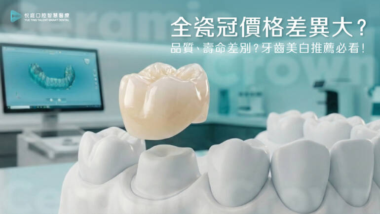 全瓷冠價格差異大？品質、壽命差別？牙齒美白推薦必看！