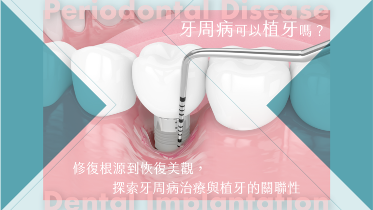 牙周病可以植牙嗎？修復根源到恢復美觀，探索牙周病治療與植牙的關聯性