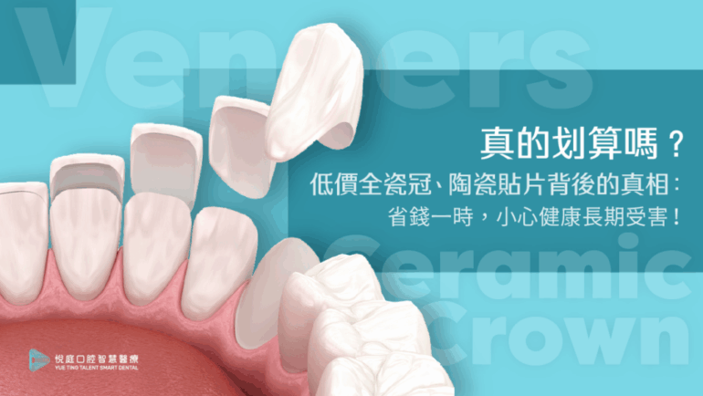 一顆一萬好划算？低價全瓷冠、陶瓷貼片背後的真相：省錢一時，小心健康長期受害！