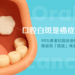 口腔白斑是癌症前兆？90%患者初期沒感覺！拖延恐「癌變」成惡性腫瘤！？