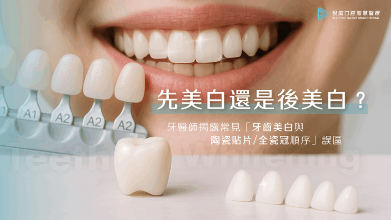 先美白還是後美白？牙醫師揭露常見「牙齒美白與陶瓷貼片/全瓷冠」順序誤區