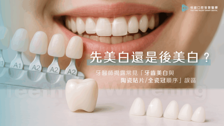 先美白還是後美白？牙醫師揭露常見「牙齒美白與陶瓷貼片/全瓷冠」順序誤區