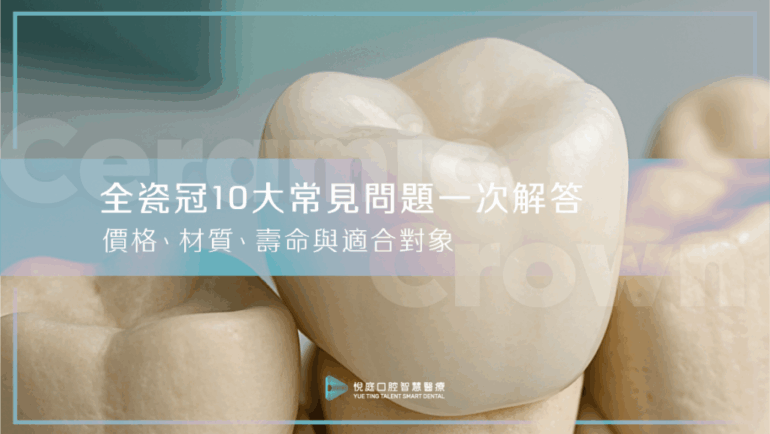 全瓷冠10大常見問題一次解答｜價格、材質、壽命與適合對象