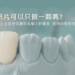陶瓷貼片可以只做一顆嗎？「單顆貼片」在前牙協調與美學上的難度、案例與常見問題解析