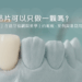 陶瓷貼片可以只做一顆嗎？「單顆貼片」在前牙協調與美學上的難度、案例與常見問題解析