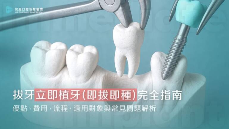 拔牙立即植牙（即拔即種）完全指南｜優點、費用、流程、適用對象與常見問題解析