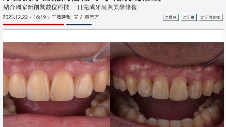 【消息報導】牙醫師也信賴的牙醫師！李承翰主任「一日美齒」同步模式，解決同業長年牙縫困擾