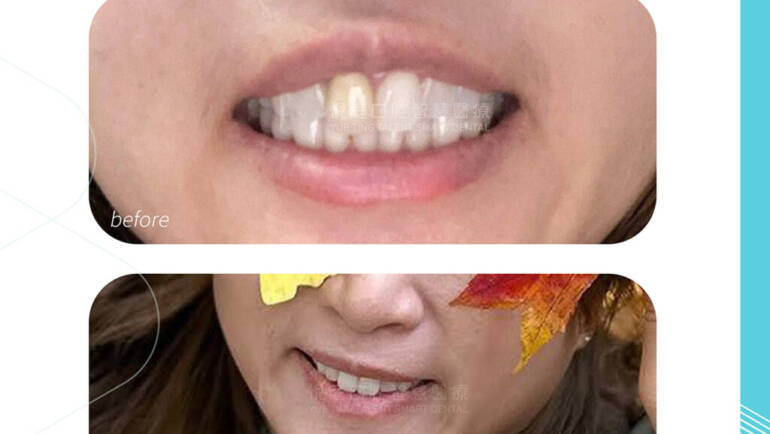 【台北牙齒美白與全瓷冠推薦】告別牙齦發黑！懶人也能輕鬆達陣的「時間管理大師」換牙記