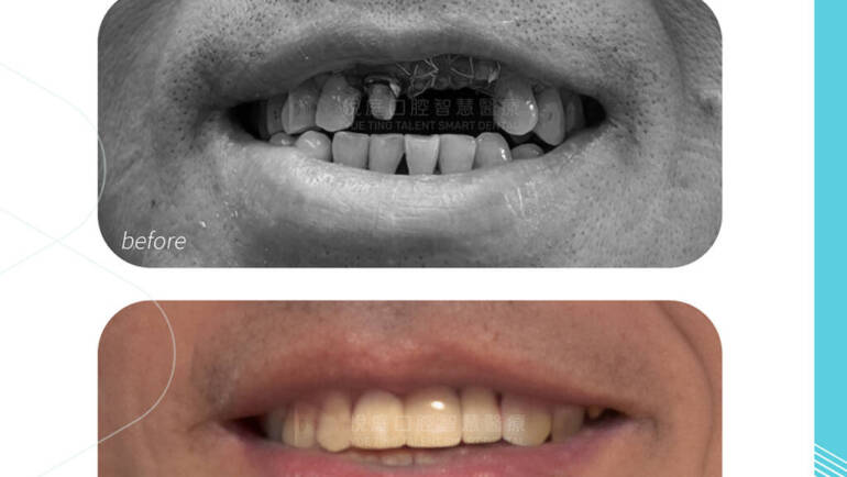 【台北植牙全瓷冠推薦】硬漢舅舅的 500 天植牙全記錄：顯微根管 × 補骨 × 一日全瓷冠