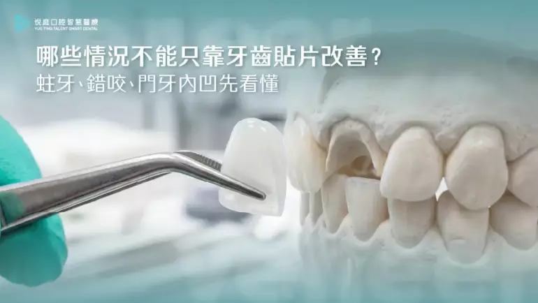 哪些情況不能只靠牙齒貼片改善？蛀牙、錯咬、門牙內凹先看懂