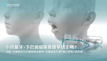 小孩暴牙、下巴後縮需要提早矯正嗎？牙醫、耳鼻喉與兒科醫師聯合解析：先確認是不是「張口呼吸」惹的禍