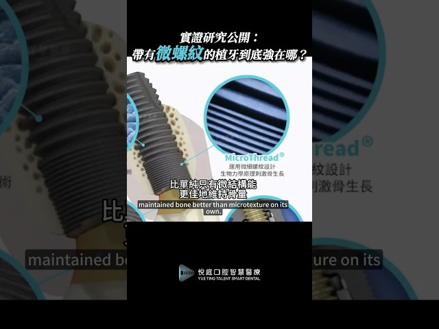 植牙怕咬東西骨頭裂？Astra植體發明者、國際骨整合學會前主席 Dr. Norton 揭密 Astra「微螺紋」如何精準分散咬合力保住地基